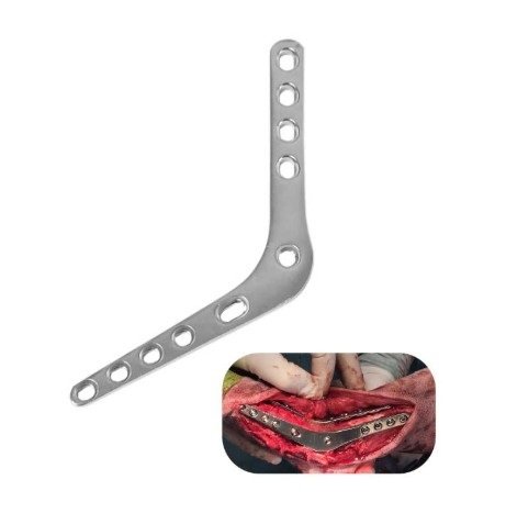 Medial Pantarsal Arthodesis Plates